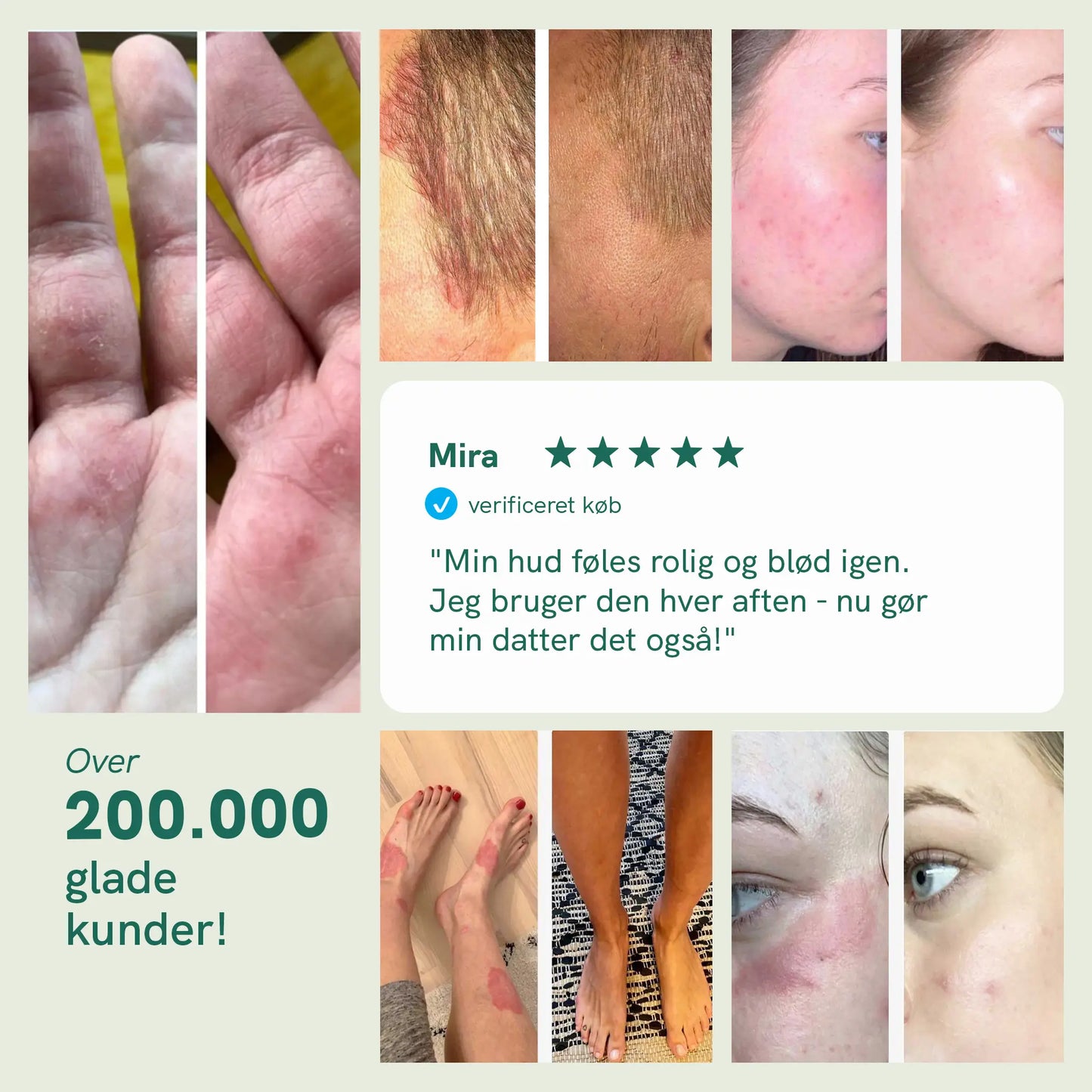 Kollage af hududslæt og rødme på hænder, ansigt og ben med før- og efterbilleder og en kundeudtalelse.
